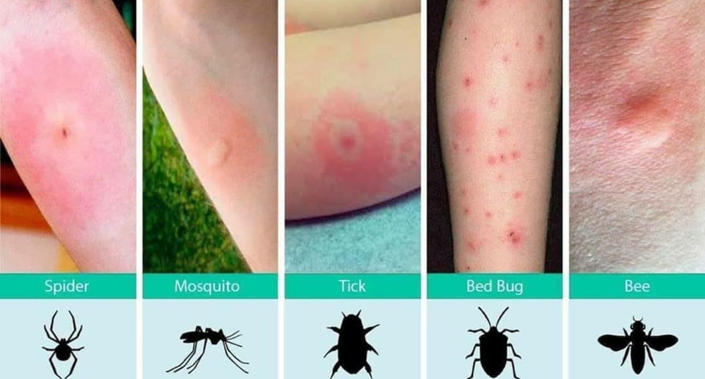 identifying mosquito bites a comprehensive guide to recognizing them